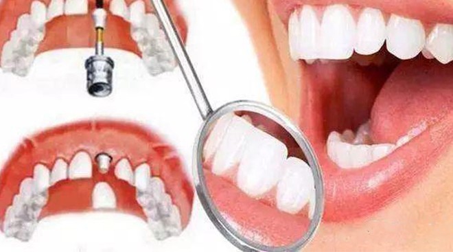 高清细节图解：种植牙的全过程，一看就懂！